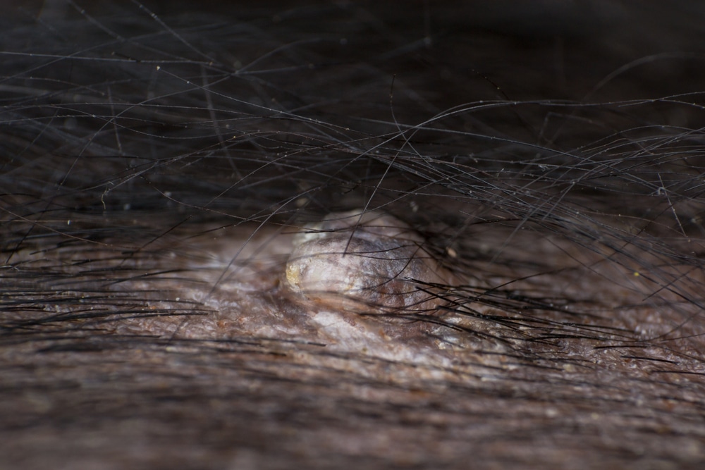 Close-up of a raised, round, skin-colored bump on human skin, partially covered by dark hair. The bump appears rough in texture and is surrounded by scattered hair strands.